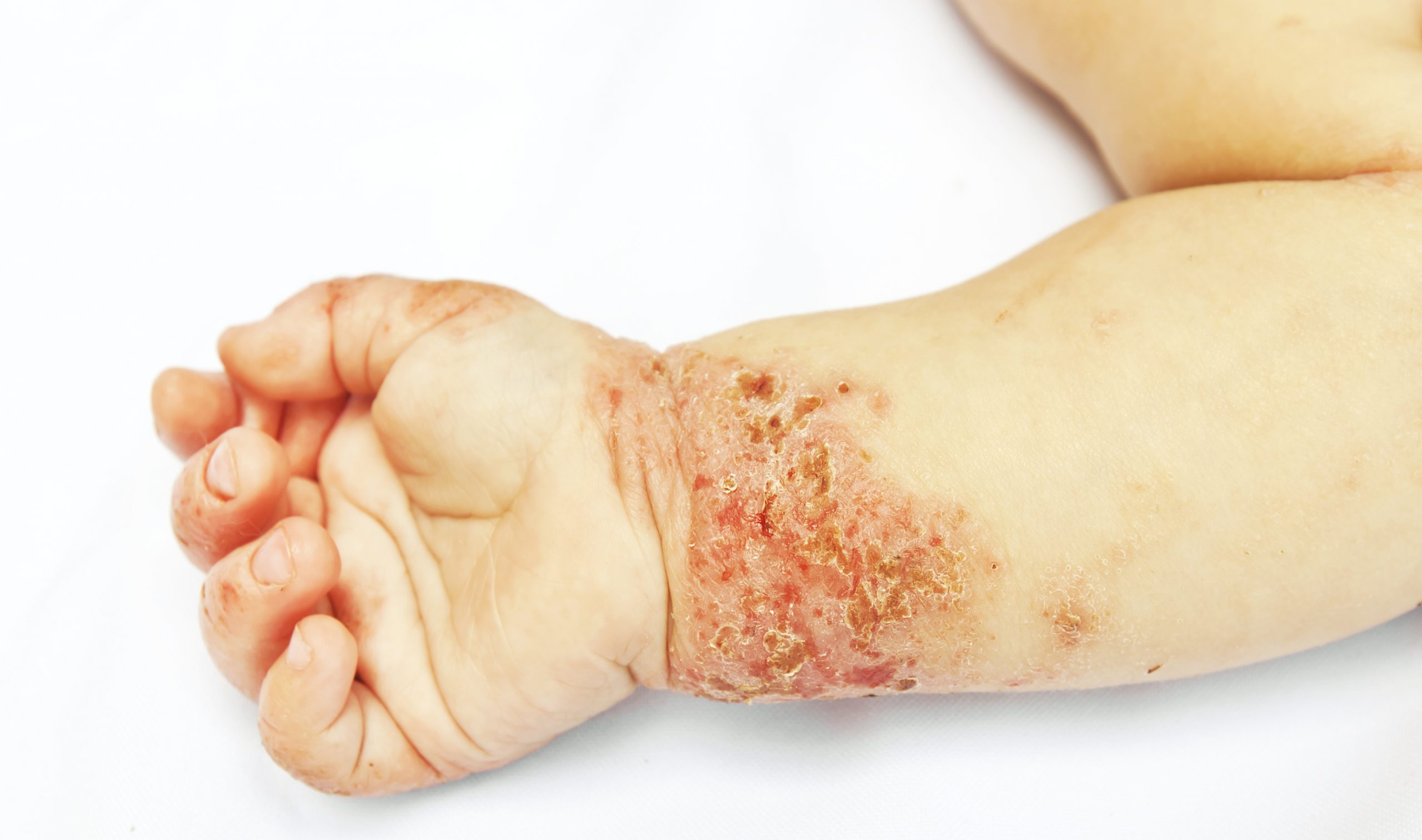 Eczema – More Than Just an Itchy Rash - Healthed