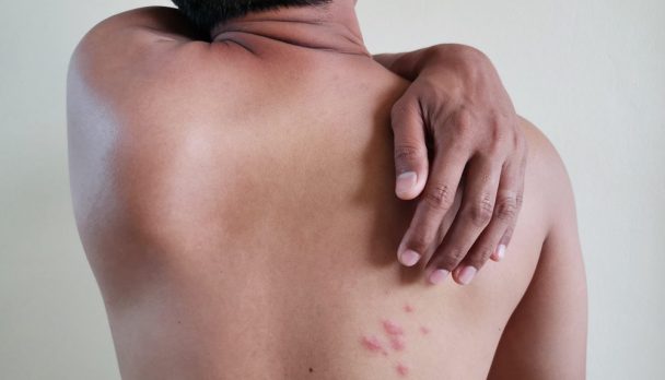 Skin,Diseases.,A,Man,Scratching,His,Back.,Painful,Back,Skin